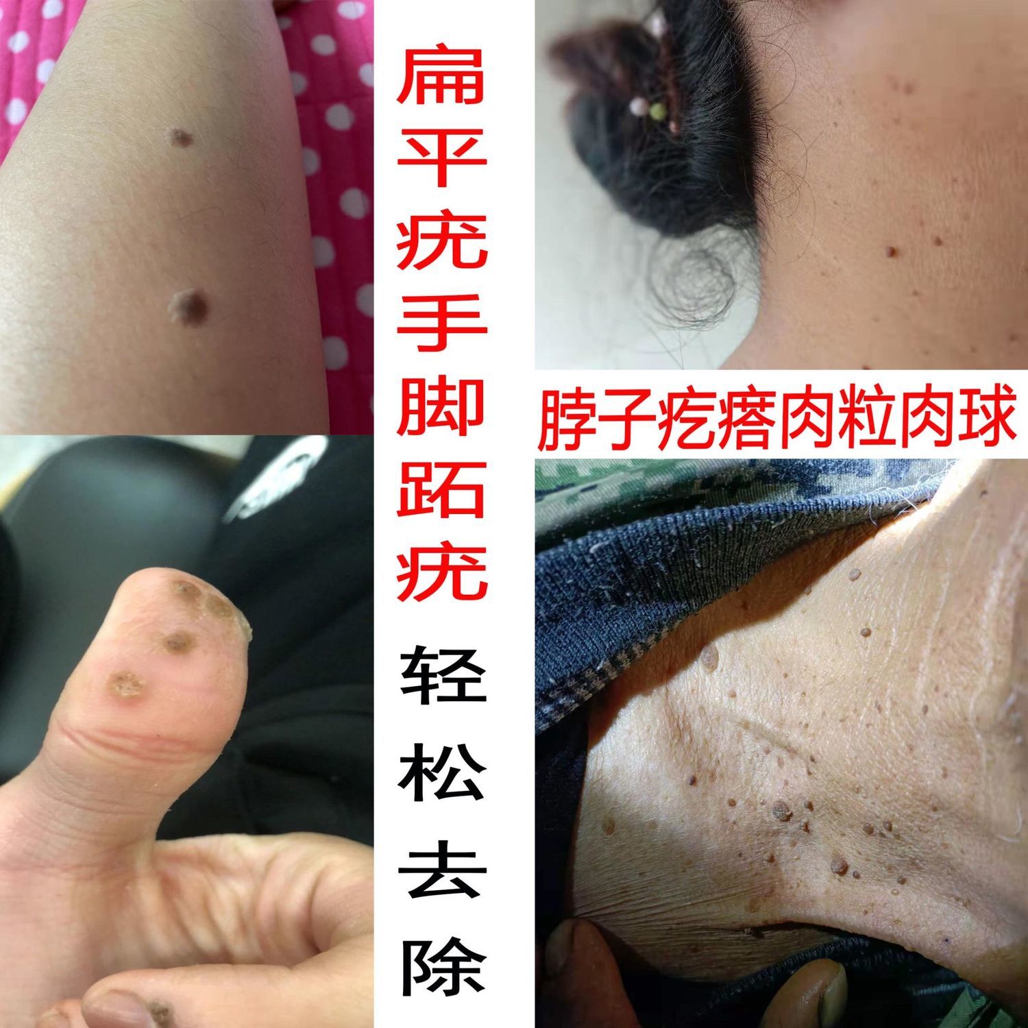何药师去除脖子肉粒猴子疙瘩手脚肉刺丝状尤腋下尤鸡眼祛疣液拼团中
